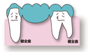 従来の治療：歯が中間で1本抜けた場合（ブリッジ）
